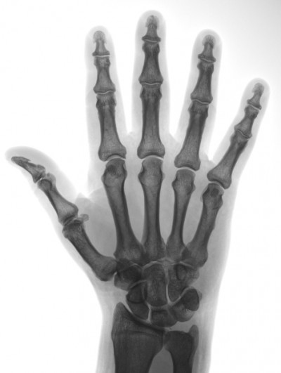 mano biomeccanica - radiografia